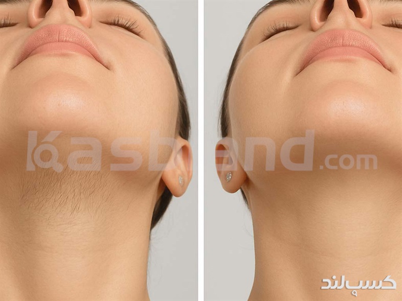 لیزر، بهترین روش حذف موهای زائد