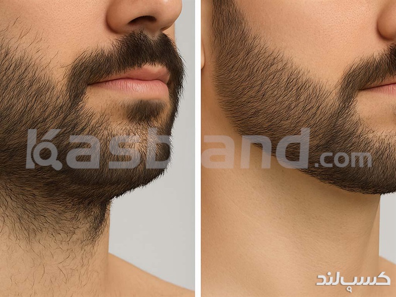 لیزر موهای زائد برای مردان