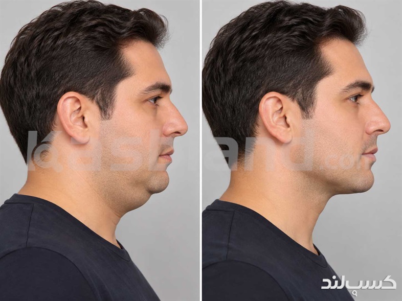 مراقبت های قبل و بعد از رفع غبغب