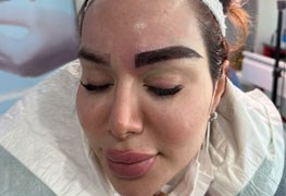 نمایش توضیحات کاشت ابرو