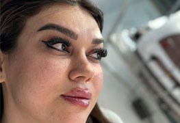 نمایش توضیحات تزریق ژل و فیلر