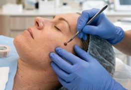 نمایش توضیحات برداشتن خال ، زگیل و سایر ضایعات پوستی