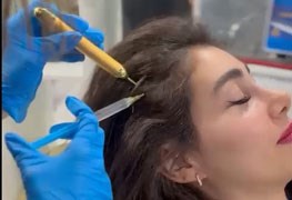 نمایش توضیحات مزوتراپی مو
