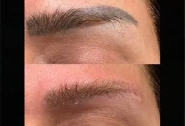 نمایش توضیحات ریموو تتو