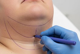 نمایش توضیحات تخلیه غبغب