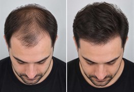 نمایش توضیحات کاشت مو و ابرو