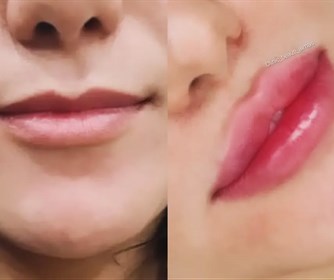 تزریق ژل لب روسی