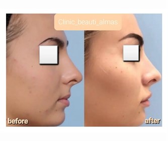 تزریق فیلر به گونه و چانه