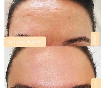 تزریق بوتاکس