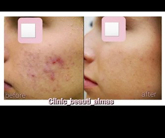 خدمات میکرونیدلینگ