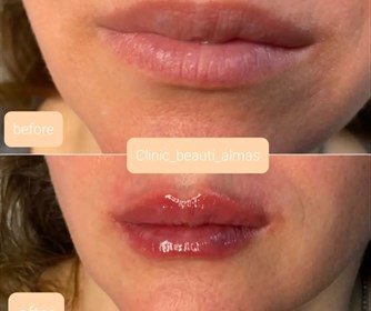 تزریق ژل لب