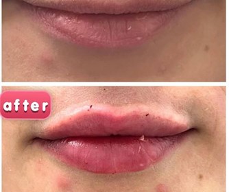 نمونه هایی از تزریق فیلر و ژل لب در مرکز زیبایی آرمیتا