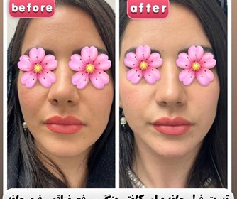 نمونه هایی از تزریق فیلر فک و چانه در مرکز زیبایی آرمیتا