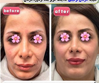 نمونه ای از آر اف فرکشنال ، کربوکسی تراپی و جوانساز
