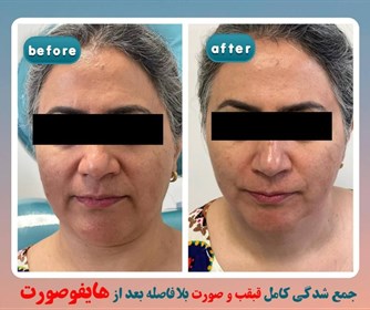 نمونه ای از هایفوتراپی صورت در مرکز زیبایی آرمیتا