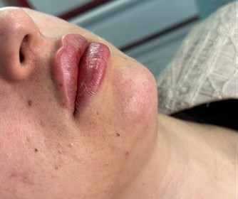 نمونه هایی از تزریق فیلر لب در مطب پوست و زیبایی و لیزر آیشیل