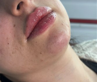 نمونه هایی از تزریق فیلر لب در مطب پوست و زیبایی و لیزر آیشیل