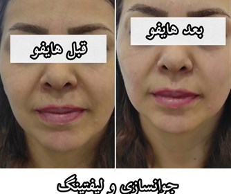 نمونه ای از هایفوتراپی در مطب پوست و زیبایی و لیزر آیشیل