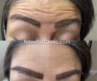 نمونه های تزریق بوتاکس