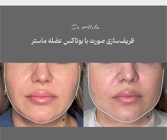 نمونه ای از تزریق بوتاکس