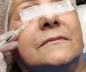 نمونه ای از تزریق ژل در کلینیک