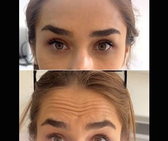 عکس هایی از تزریق بوتاکس انجام شده در مرکز زیبایی