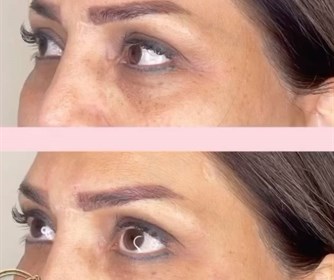 عکس هایی از تزریق فیلر زیر چشم انجام شده در مرکز زیبایی