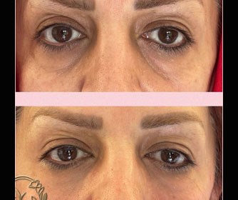 عکس هایی از تزریق فیلر زیر چشم انجام شده در مرکز زیبایی