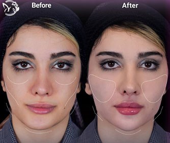 تزریق فول فیس برای تعادل، جوانسازی و زیبایی طبیعی در مرکز زیبایی