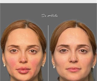 نمونه هایی از تزریق فیلر کامل صورت