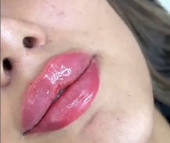 تزریق فیلر لب در کلینیک زیبایی گندم