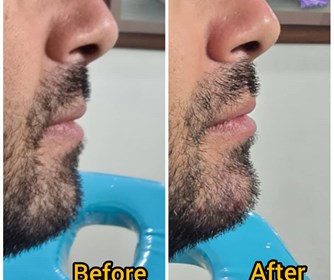 تزریق فیلر در کلینیک زیبایی گندم