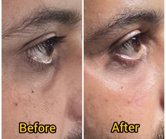 فیلر زیر چشم جهت رفع گودی زیر چشم