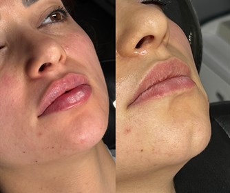 نمونه هایی از تزریق فیلر لب