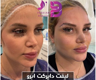 نمونه های خدمات لیفت ابرو