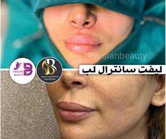 نتیجه لیفت سانترال لب