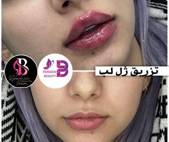 نتیجه تزریق ژل لب