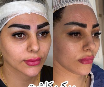 نتیجه میکرو کاشت ابرو