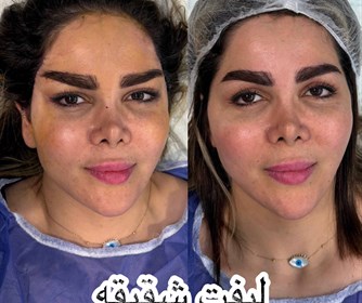 نتیجه لیفت شقیقه