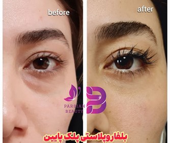 نتیجه خدمات بلفاروپلاستی