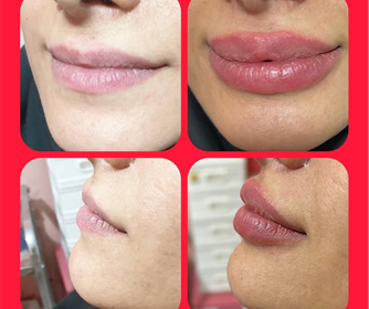 نمونه هایی از تزریق ژل لب