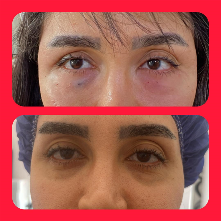 نمونه تزریق چربی زیر چشم