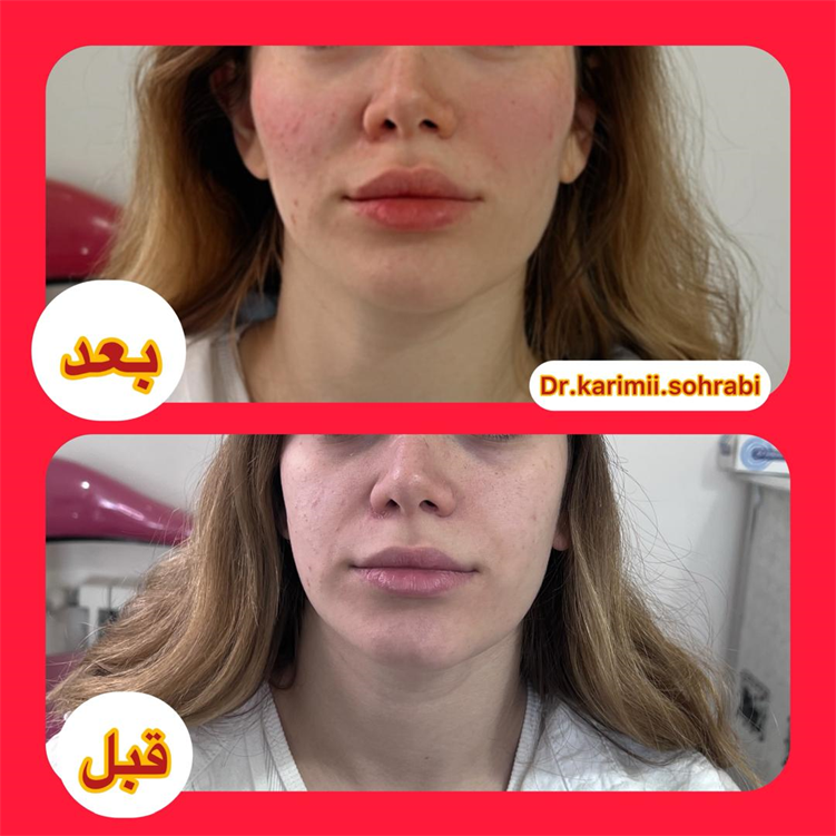 نمونه هایی از تزریق ژل گونه