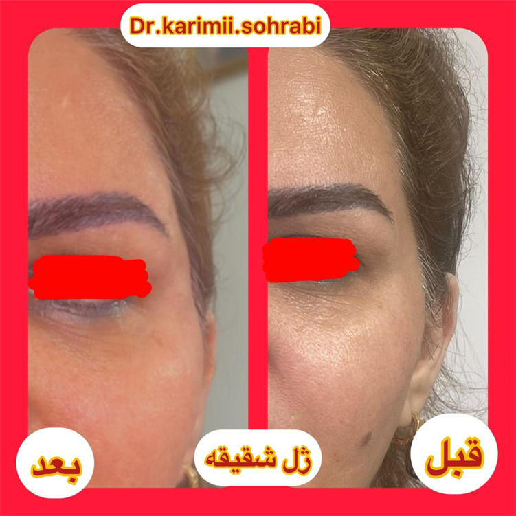 نمونه تزریق ژل شقیقه