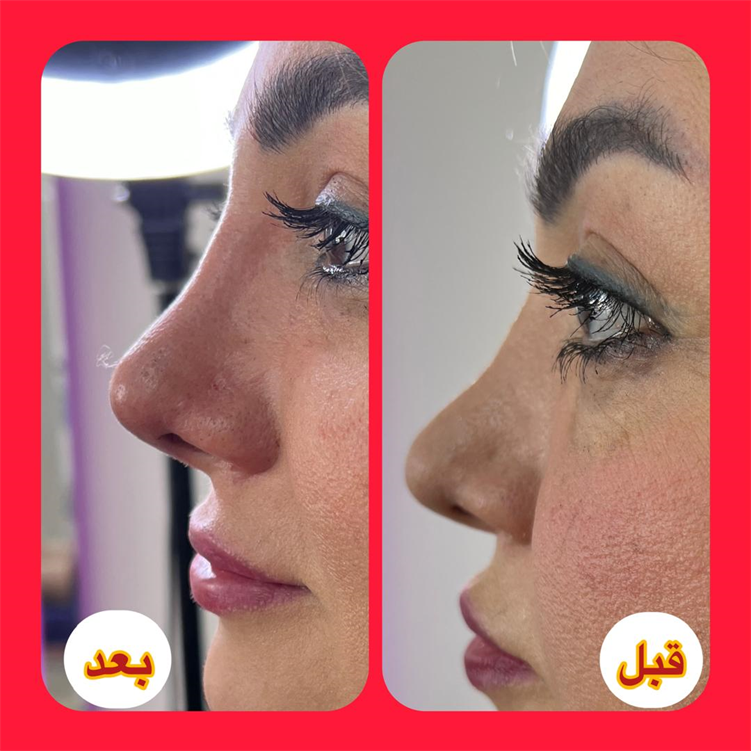 نمونه لیفت بینی