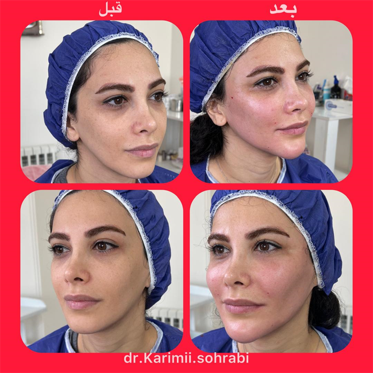 نمونه هایی از تزریق چربی صورت