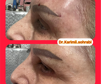 نمونه ای از لیفت ابرو با نخ
