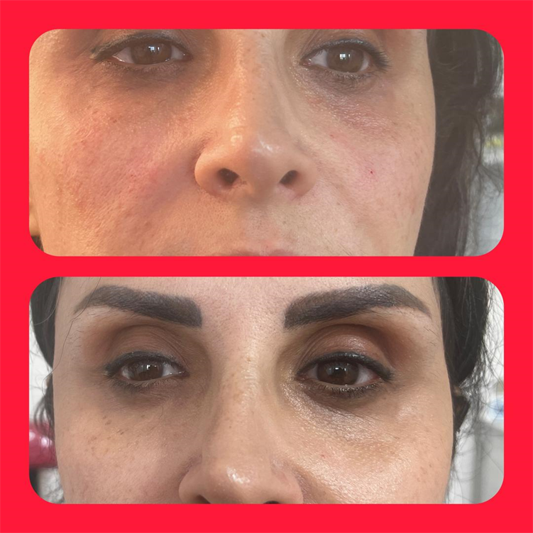 نمونه تزریق ژل زیر چشم